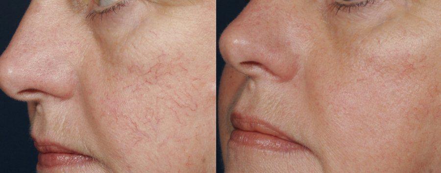 фото до и после удаления сосудистой сетки на лице