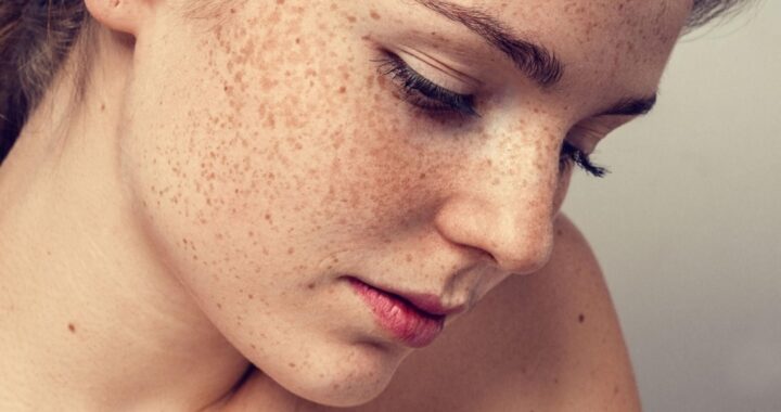 Гиперпигментация на коже и как от нее избавиться